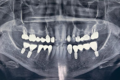 Имплантаты в боковых отделах нижней челюсти на панорамной рентгенограмме.